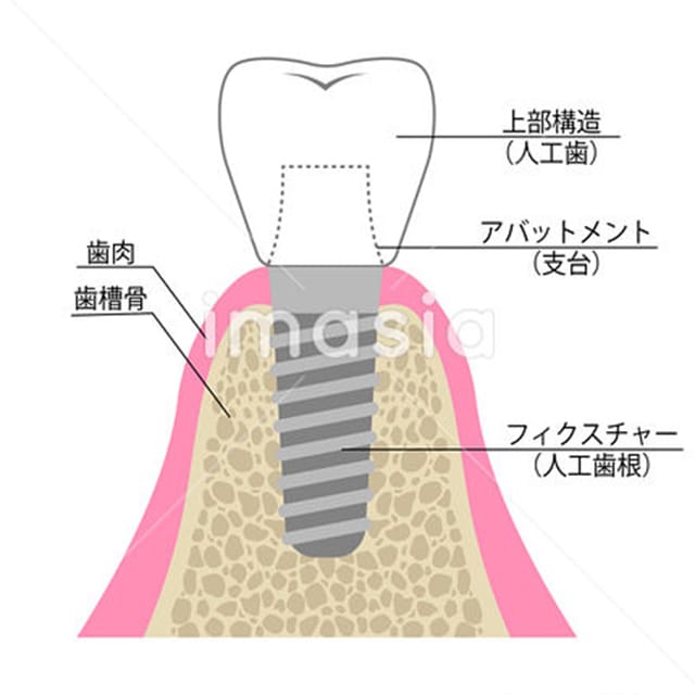 インプラントの構造